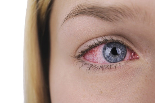 how to cure red veins on white eyes